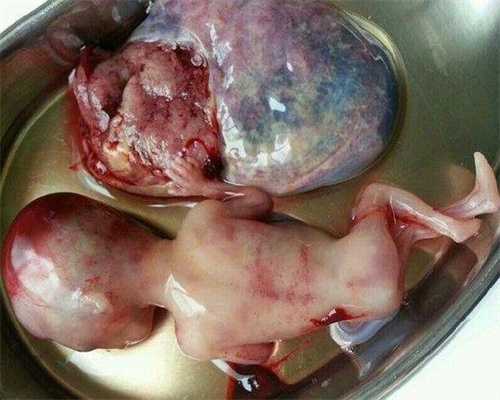 广州哪个医院有供卵_闭经做供卵试管婴儿_怀孕如何预防宝宝胎记 别让胎记毁了